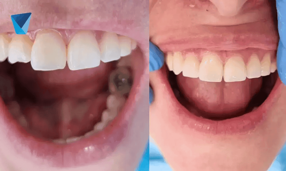 Resultado estético de blanqueamiento dental en Dentistas por Chile