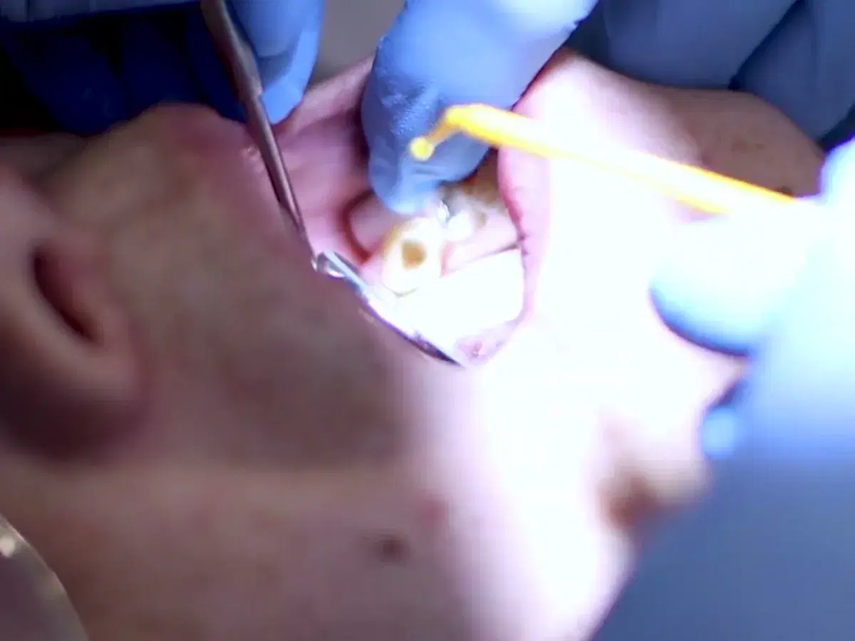 Molar aislado con algodones y la cavidad ya tallada, con el espejo separando la mejilla y un microaplicador amarillo entrando a la boca