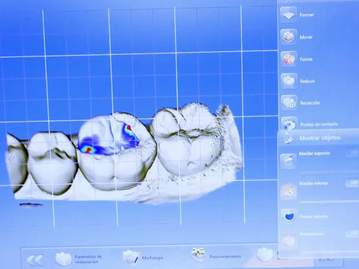 Pantalla del software de diseño con el escaneado 3D de tres molares y una zona marcada en colores sobre la cara de masticar