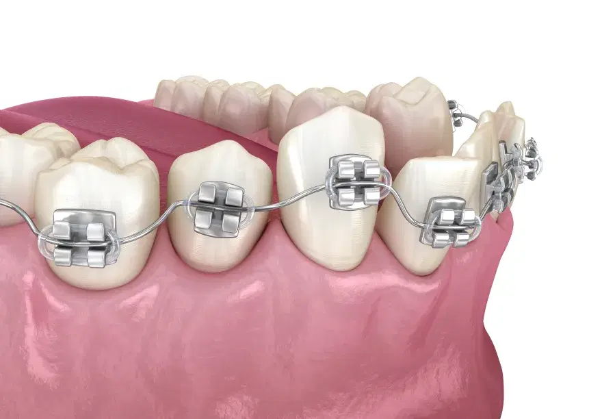 Brackets metálicos pegados a los dientes y el alambre que va llevando a su sitio a la pieza girada
