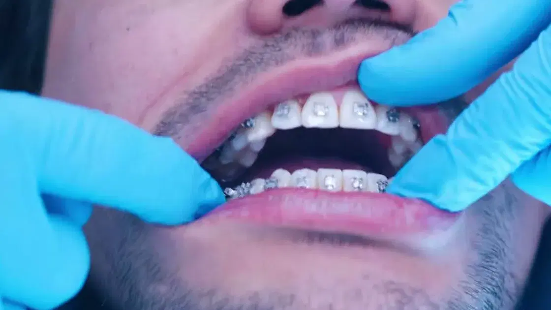 Brackets metálicos ya cementados en los dientes de arriba y de abajo, con dos manos enguantadas separando los labios