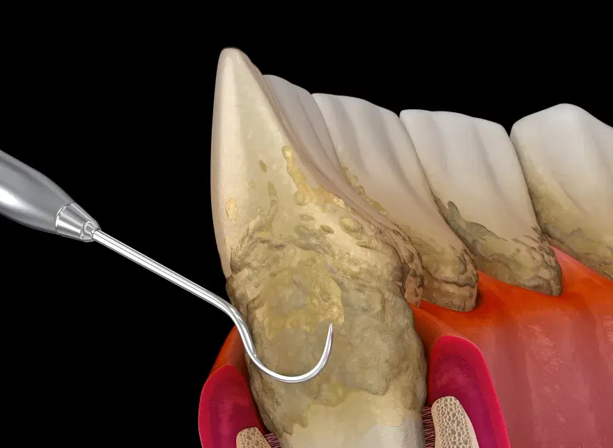 Periodontitis avanzada: sarro bajo la encía inflamada y el hueso ya retirado del diente