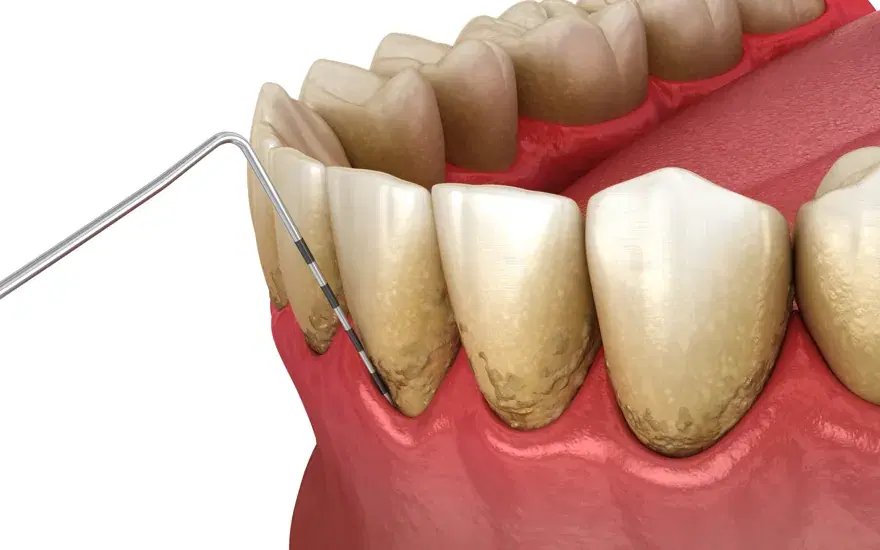Sonda periodontal graduada midiendo la profundidad de la bolsa