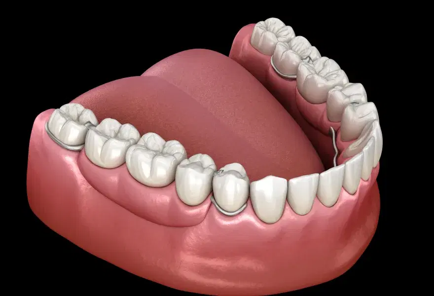 Prótesis parcial con armazón metálico apoyada sobre los dientes que quedan