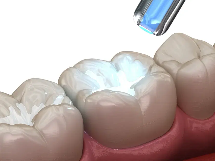 Resina compuesta rellenando la cavidad del molar mientras la lámpara la fotocura