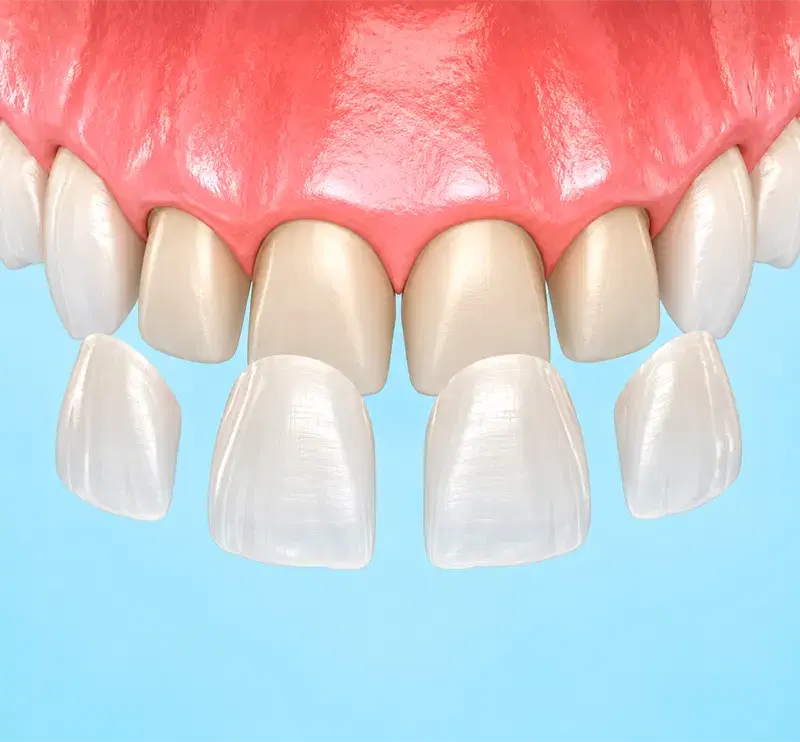 Carillas de cerámica delgadas colocándose sobre los dientes anteriores superiores
