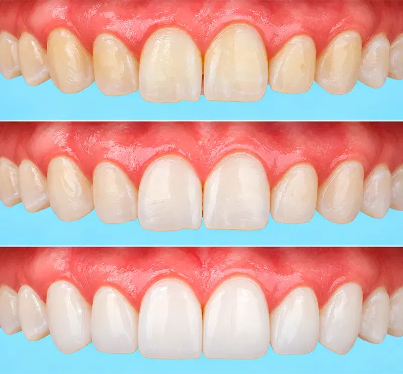 Los dientes anteriores superiores en tres pasos del diseño de sonrisa, de bordes irregulares y tono amarillento a una sonrisa pareja y clara