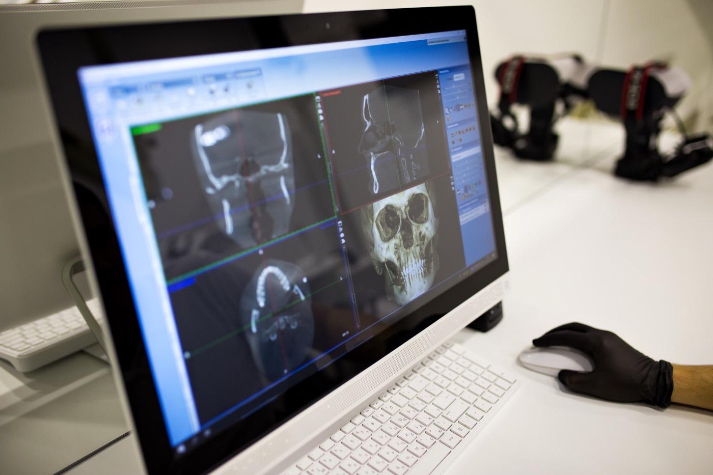Escáner 3D de ambos maxilares para planificar implantes en toda la boca