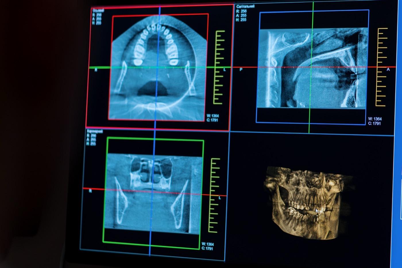 Cortes de un escáner dental 3D y la reconstrucción del maxilar en pantalla