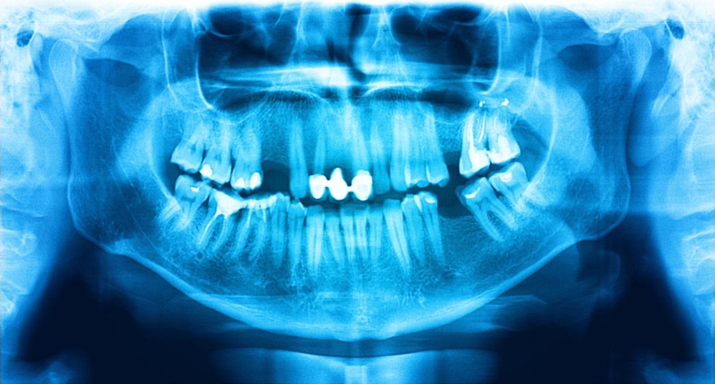 Radiografía panorámica dental: los dientes y ambos maxilares en una sola imagen