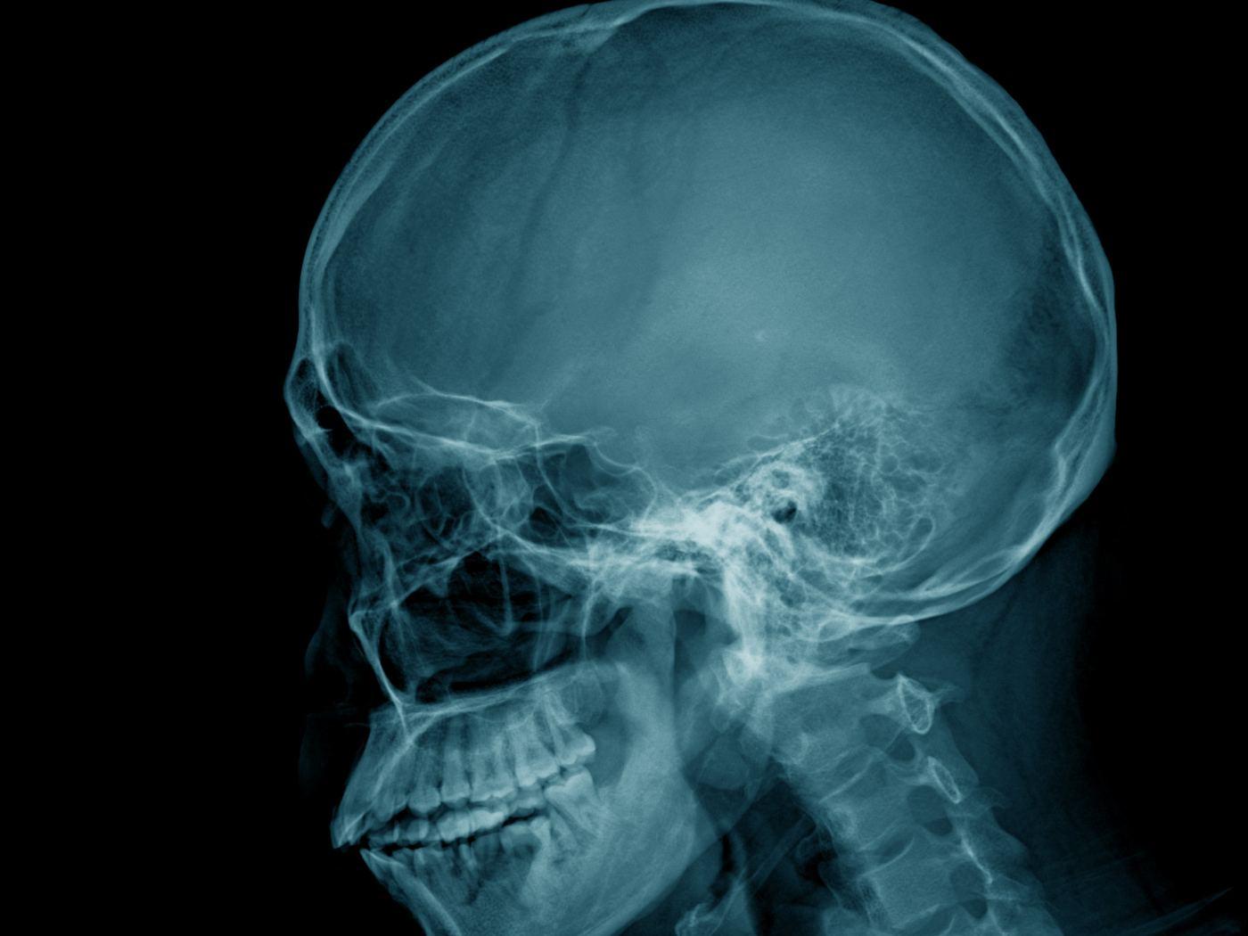 Radiografía lateral de cráneo: perfil de los huesos de la cara, maxilar y mandíbula