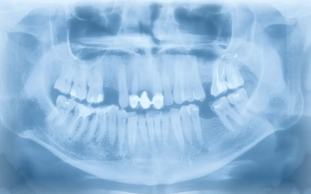 Radiografía panorámica dental: los dientes y ambos maxilares en una sola imagen