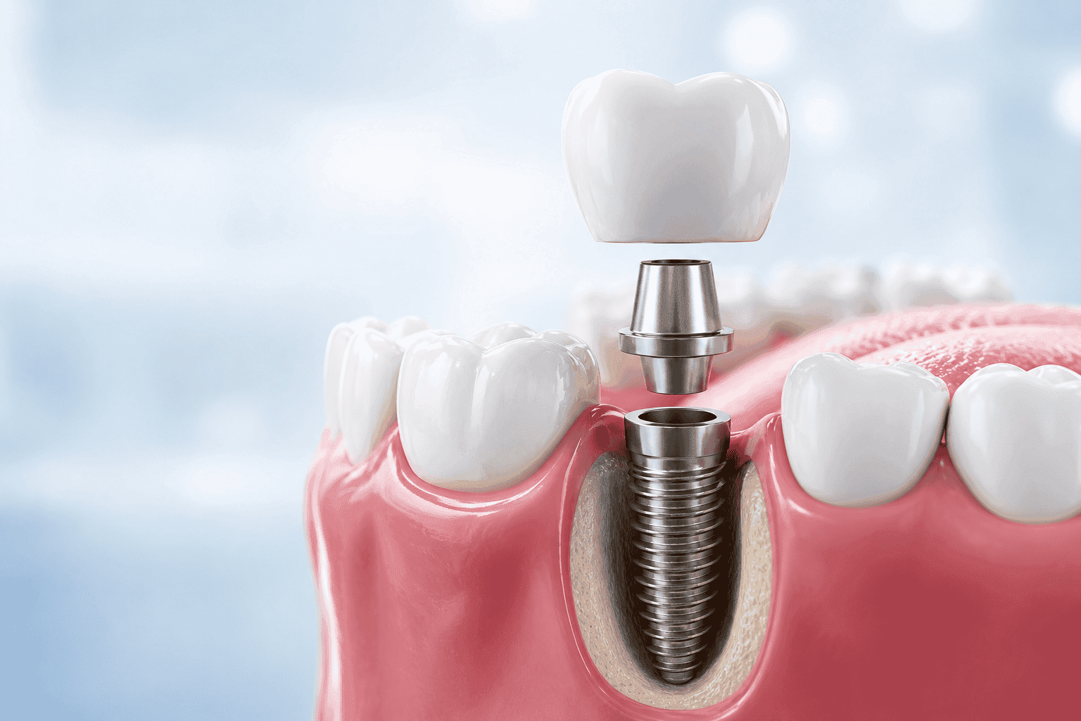 Ilustración de un implante dental de titanio con su corona