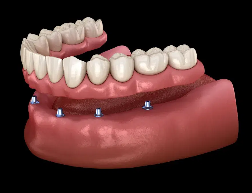 Prótesis híbrida atornillada sobre implantes