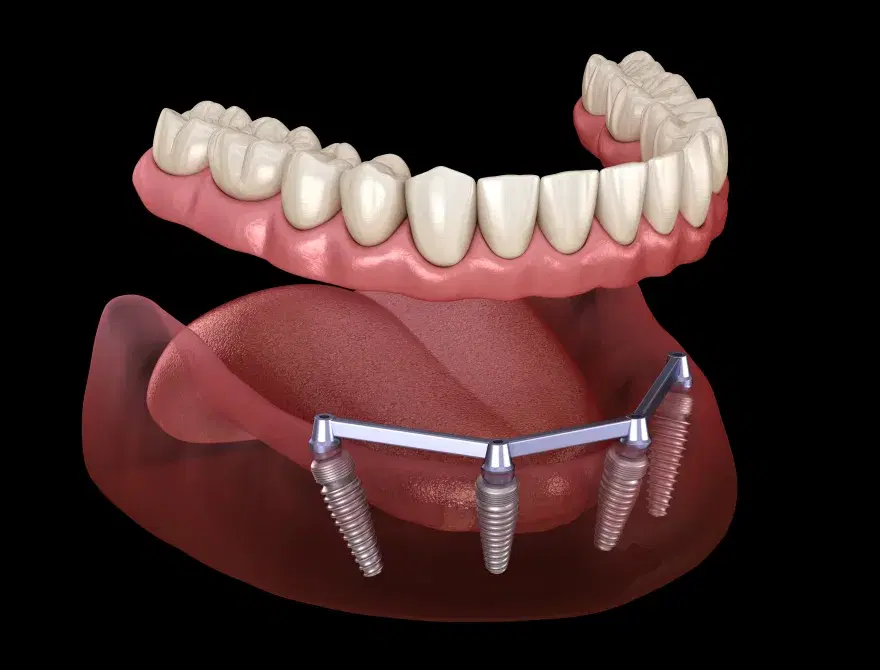 Sobredentadura sobre implantes