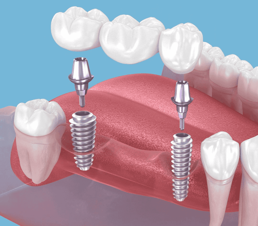 Ilustración de implantes dentales con coronas