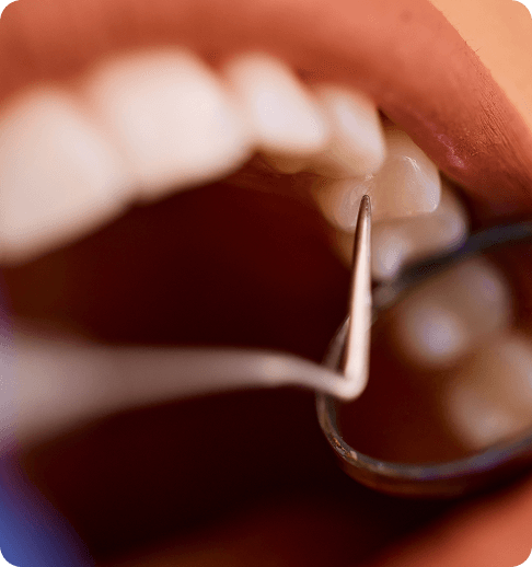 Ilustración del proceso paso a paso para implantes dentales