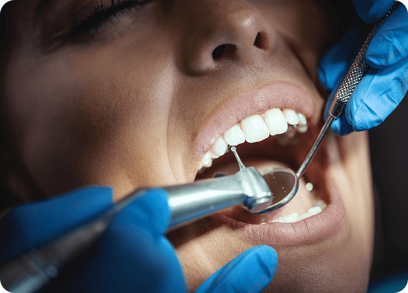 Restauración dental con resina