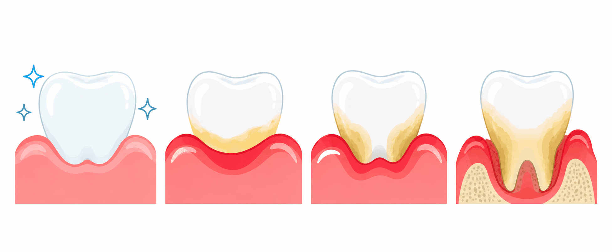 Enfermedad periodontal: de encías sanas a periodontitis