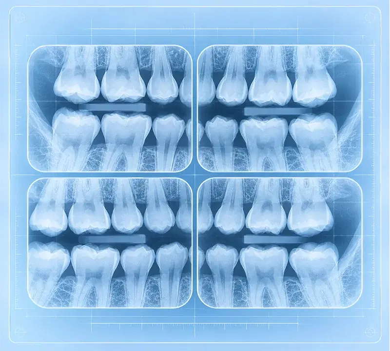 Radiografía Bite Wing: coronas de molares y premolares superiores e inferiores en una sola toma