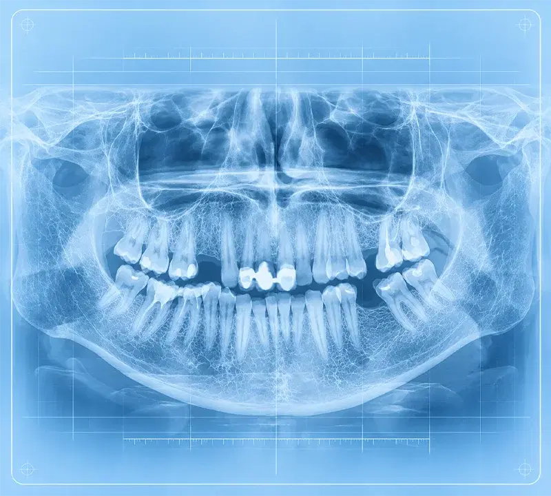 Radiografía panorámica dental: los dientes y ambos maxilares en una sola imagen