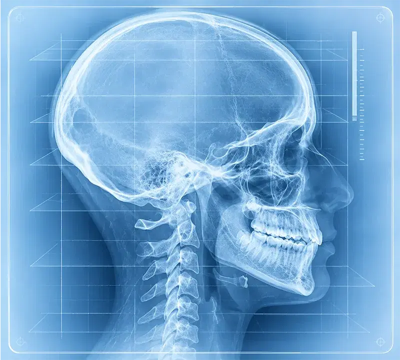 Radiografía lateral de cráneo: perfil de los huesos de la cara, maxilar y mandíbula
