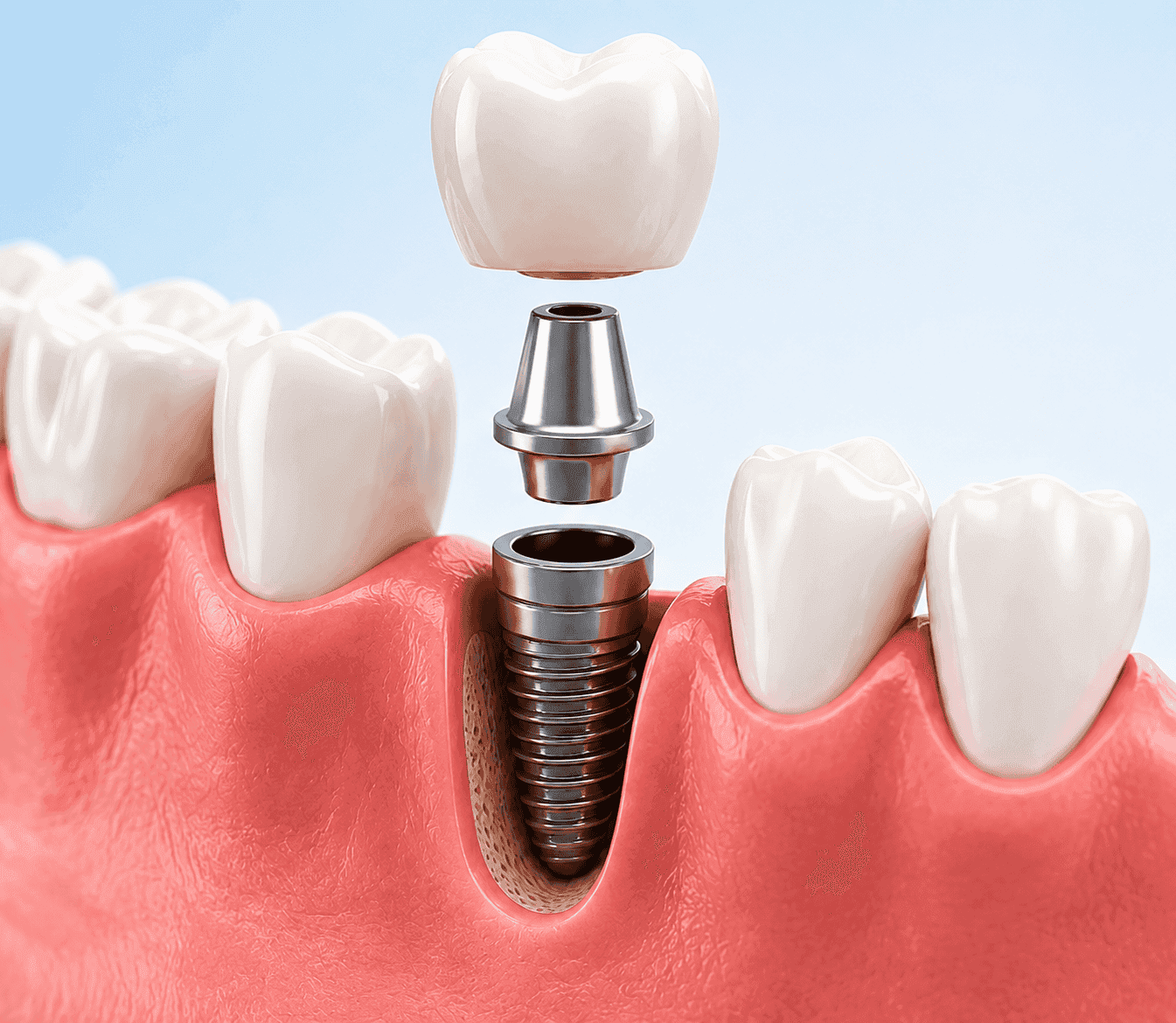 Implante dental de titanio con corona instalándose en la encía