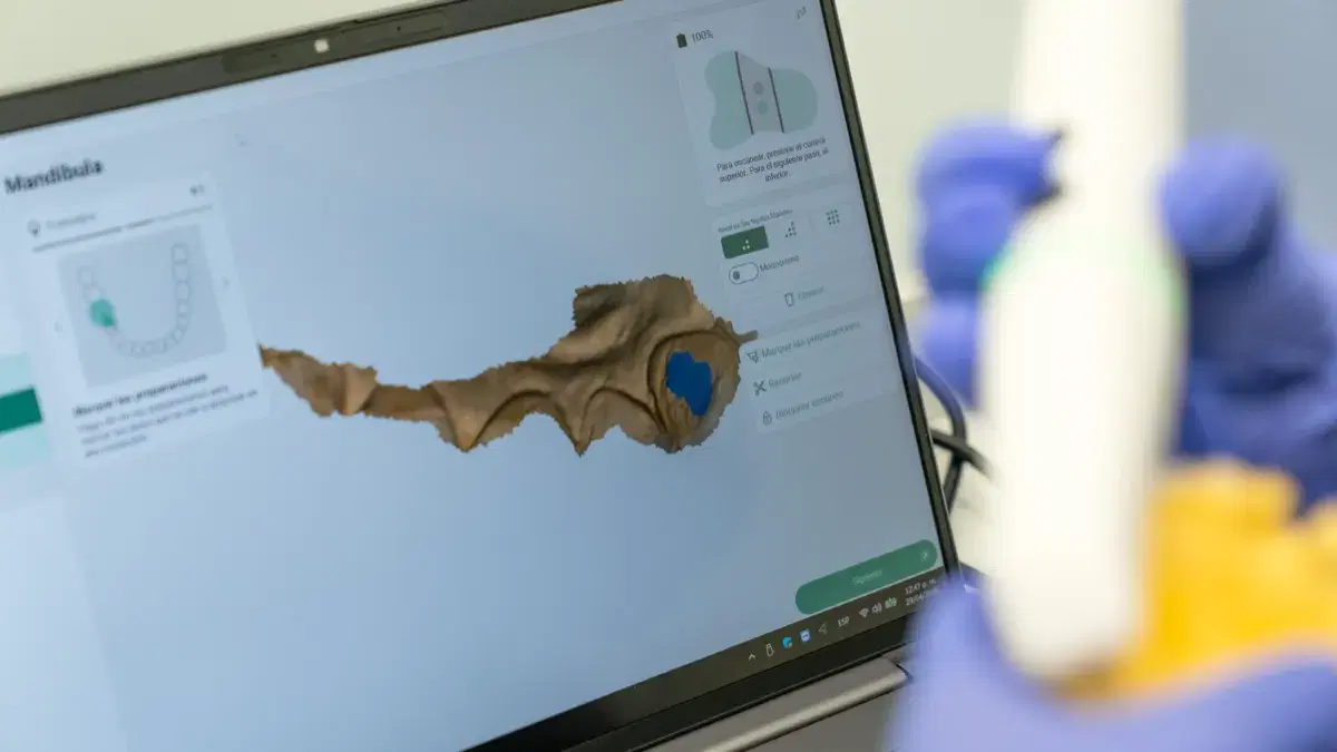 Escáner intraoral digital junto a la pantalla que muestra el modelo 3D de la arcada
