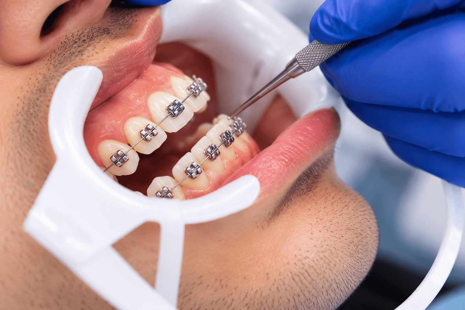 Imagen ilustrativa de un tratamiento de ortodoncia con brackets metálicos. Acompaña un artículo educativo sobre los principales mitos y realidades del uso de brackets, sus cuidados y funcionamiento. Clínica Dentistas por Chile, Providencia, Santiago. Mitos de Ortodoncia. Dentistas por Chile
