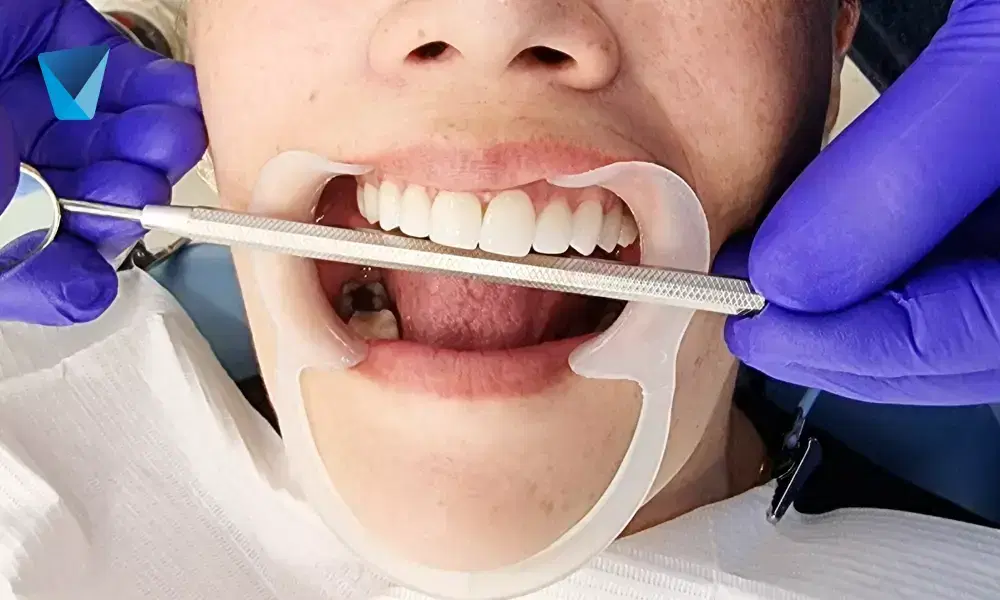 Imagen de portada del blog 'Blanqueamiento Láser: La Luz que Transforma tu Sonrisa', mostrando los beneficios del tratamiento dental para una sonrisa más blanca y radiante en Chile. Blanqueamiento Láser Dental en Chile: Transforma tu Sonrisa
