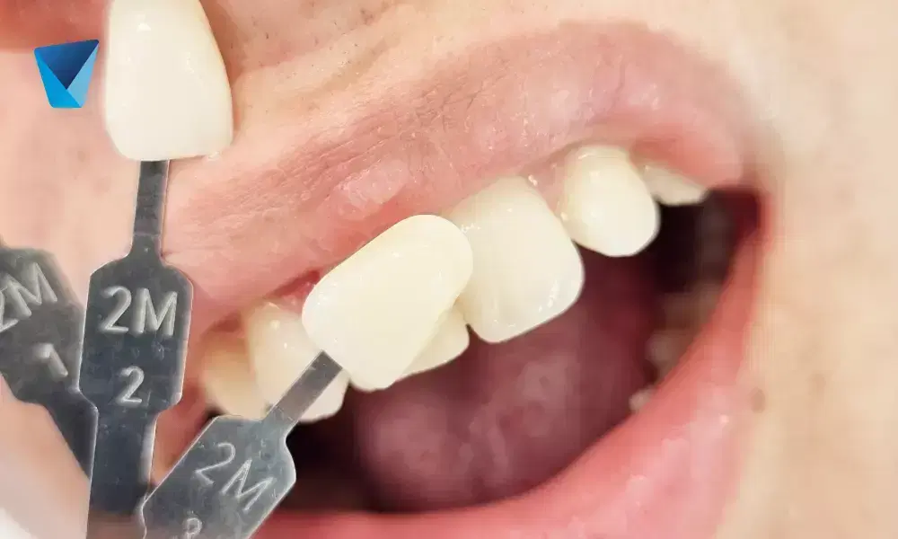 Compara carillas dentales y dientes naturales para una sonrisa perfecta. Descubre cómo lograr la estética de celebridades en Chile. Información útil para tu decisión. Carillas Dentales vs. Dientes Naturales: Logra Sonrisas como las de Famosos
