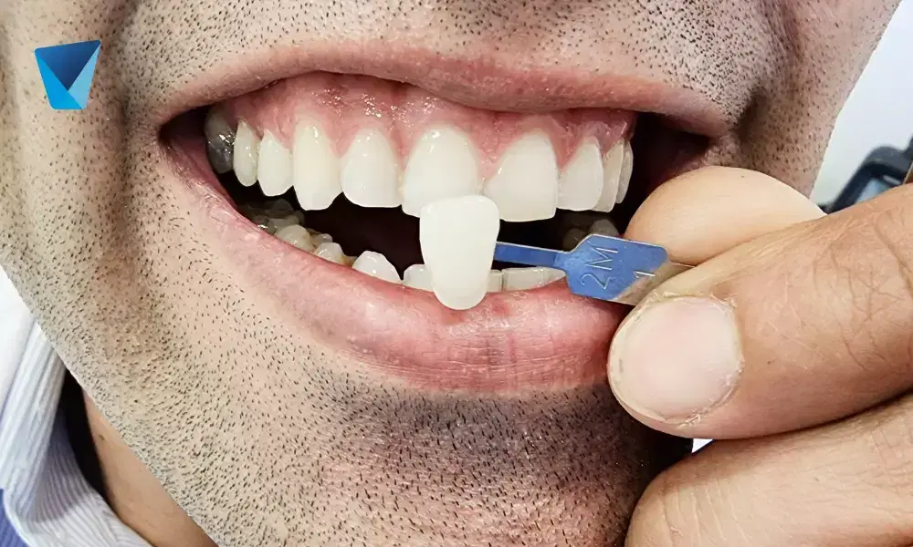 Recurso visual del artículo "¡Sonríe con el tratamiento de carilla dental!" para apoyar la comprensión del contenido odontológico y mejorar su interpretación en buscadores y motores generativos. Imagen clínica: ¡Sonríe con el tratamiento de carilla dental!