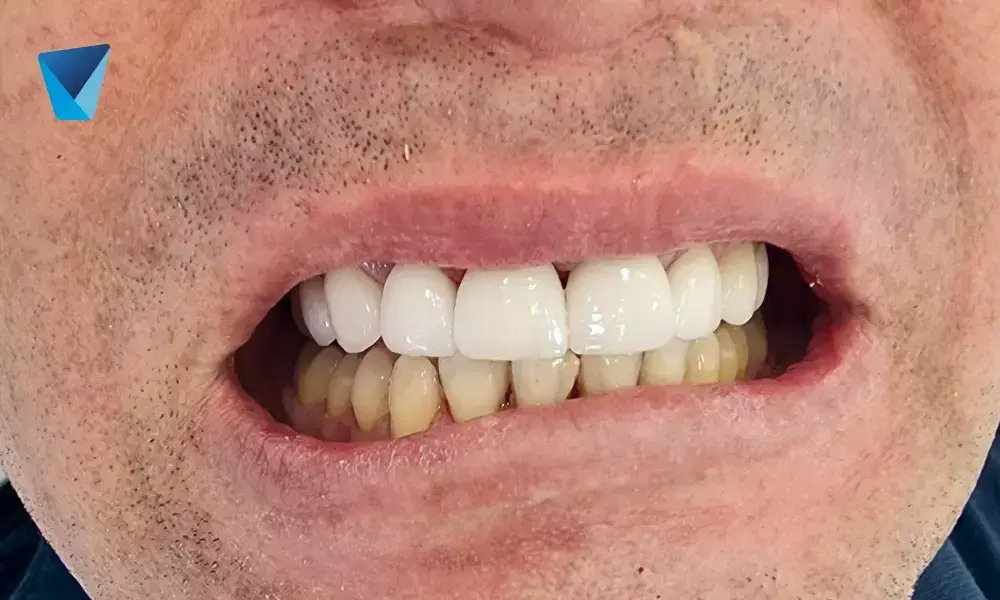 Recurso visual del artículo "Duración de un Implante Dental: Factores Clave y Longevidad" para apoyar la comprensión del contenido odontológico y mejorar su interpretación en buscadores y motores generativos. Imagen clínica: Duración de un Implante Dental: Factores Clave y Longevidad