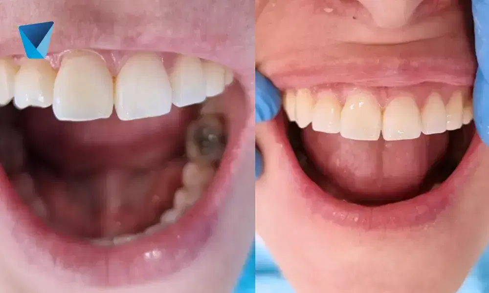 Compara los tratamientos de blanqueamiento dental láser y ozono disponibles en Chile. Conoce sus beneficios, diferencias y cuál es la mejor opción para lograr una sonrisa más blanca y saludable según tu necesidad. Blanqueamiento Dental Láser vs. Ozono: Guía para Elegir en Chile