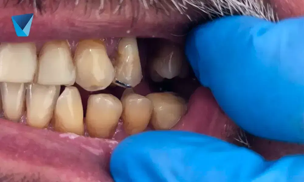 Descubre todo sobre las coronas dentales en Chile. Resolviendo las 5 preguntas más comunes sobre este tratamiento para restaurar y mejorar la estética de tus dientes. Información útil para pacientes. Coronas Dentales: Respuestas Claras a 5 Preguntas Frecuentes