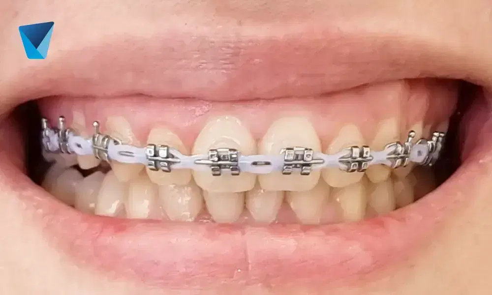 Explora la cirugía ortognática, un procedimiento de ortodoncia maxilofacial avanzado para corregir desbalances dentofaciales y mejorar la armonía facial en Chile. Descubre sus beneficios y cómo mejora la salud bucal. Cirugía Ortognática en Chile: Transformación Facial y Dental