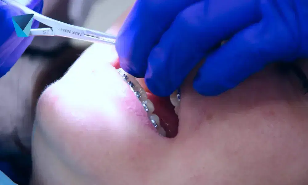 Descubre la importancia del limpiador lingual para eliminar bacterias, mejorar el aliento y mantener una higiene bucal óptima. Guía esencial para el cuidado diario de tu boca en Chile. Limpiador Lingual: Clave para Aliento Fresco y Salud Bucal en Chile