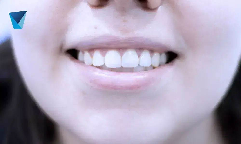 Explora las distinciones fundamentales entre estética dental y odontología cosmética. Entiende cómo cada disciplina mejora tu sonrisa y salud bucal en Chile, con foco en procedimientos y resultados para pacientes. Estética Dental vs. Odontología Cosmética: Claves y Diferencias