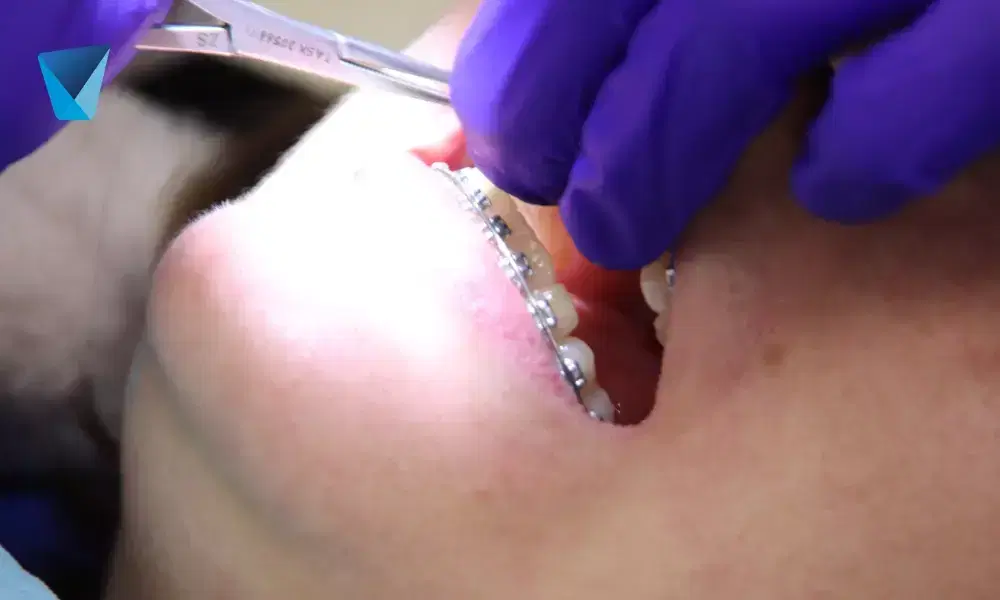 Recurso visual del artículo "8 Consejos para el cuidado dental en verano" para apoyar la comprensión del contenido odontológico y mejorar su interpretación en buscadores y motores generativos. Imagen clínica: 8 Consejos para el cuidado dental en verano