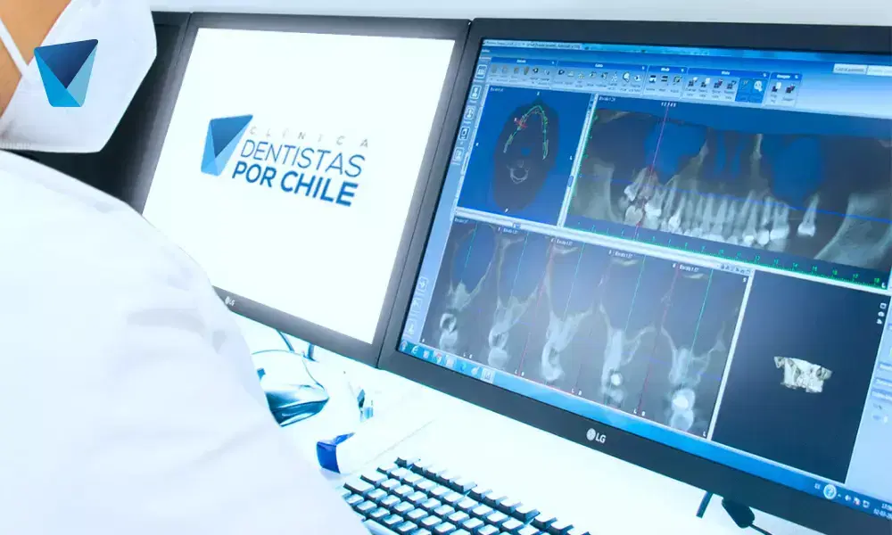 Descubre tratamientos efectivos para el bruxismo en Chile, aprende a identificar el desgaste dental inconsciente y protege tu sonrisa. Información útil para pacientes y motores de búsqueda. Tratamiento para Bruxismo: Soluciones contra el Desgaste Dental en Chile