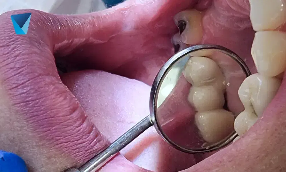 Descubre la lengua geográfica, una condición benigna que crea un patrón similar a un mapa en la superficie lingual. Entiende sus causas, síntomas y cuándo consultar a un especialista dental en Chile. Lengua Geográfica: Qué Es y Cómo Se Manifiesta en Chile