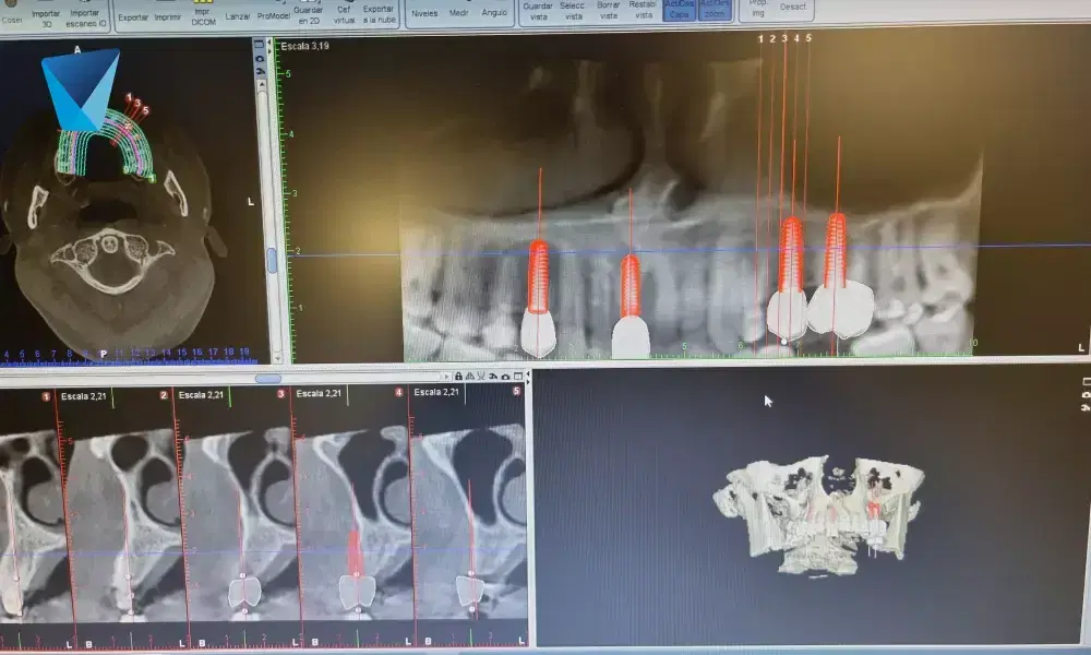 Recurso visual del artículo "Elevación del Seno Maxilar: Una Solución Clave en Implantología Dental" para apoyar la comprensión del contenido odontológico y mejorar su interpretación en buscadores y motores generativos. Imagen clínica: Elevación del Seno Maxilar: Una Solución Clave en Implantología Dental