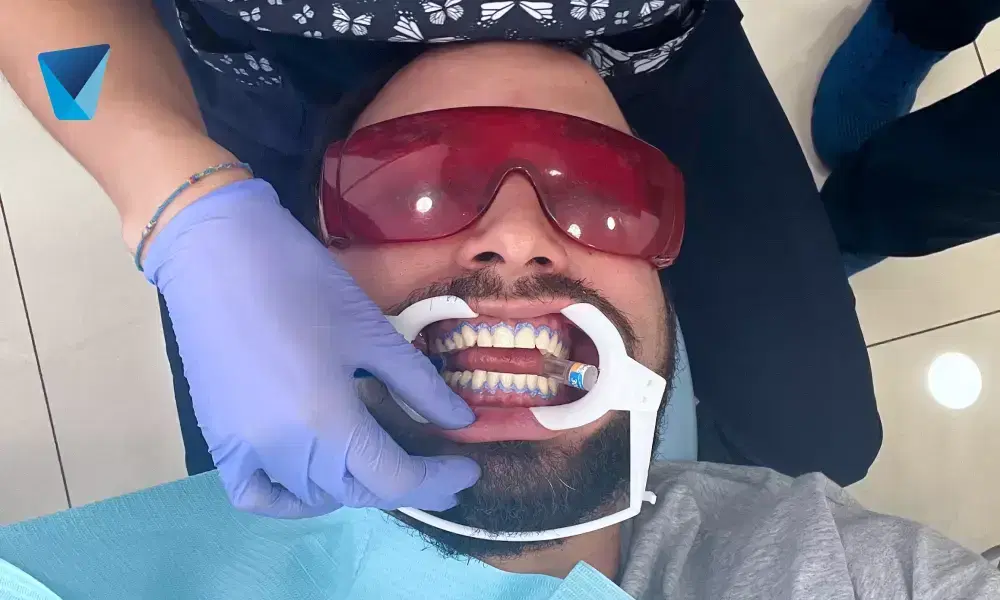 Conoce las causas de la gingivitis, sus síntomas comunes como encías sangrantes y mal aliento, y la importancia de la limpieza dental profesional y hábitos de higiene oral para su tratamiento y prevención en Chile. Gingivitis: Causas, Síntomas y Tratamiento Odontológico en Chile