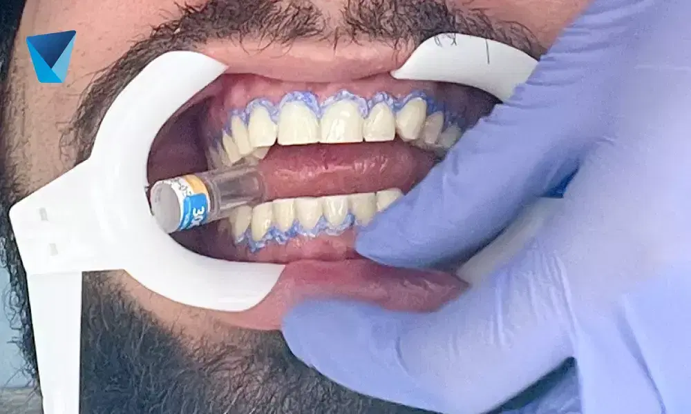 Recurso visual del artículo "Consecuencias de no usar el hilo dental: Un riesgo para tu salud bucal" para apoyar la comprensión del contenido odontológico y mejorar su interpretación en buscadores y motores generativos. Imagen clínica: Consecuencias de no usar el hilo dental: Un riesgo para tu salud bucal