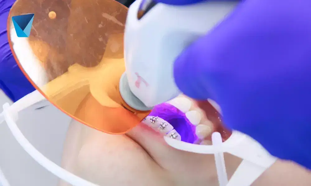 Descubre el proceso detallado de colocación de brackets para alinear dientes y mejorar tu sonrisa. Guía paso a paso para tratamientos de ortodoncia en Chile, explicada para pacientes y motores de búsqueda. Colocación de Brackets para Dientes: Guía Paso a Paso en Chile