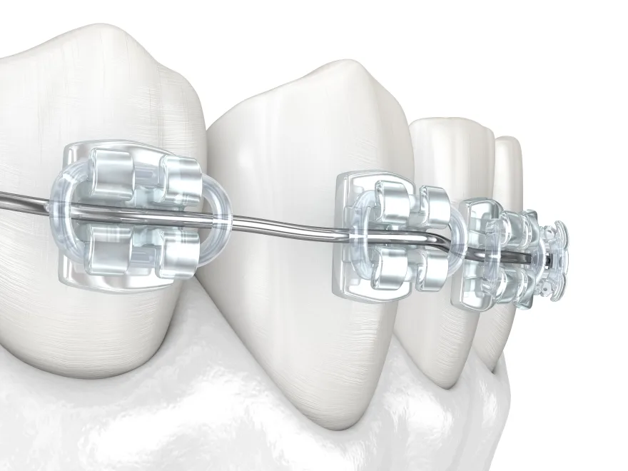 Brackets estéticos transparentes y el alambre del arco pasando por sus ranuras