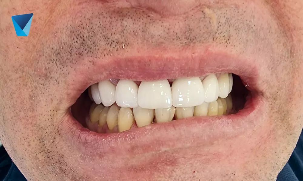 duracion de un implante dental, incrustación dental overlay
