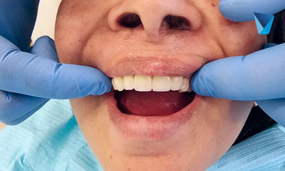 sonrisa cubierta, implantes dentales de boca completa