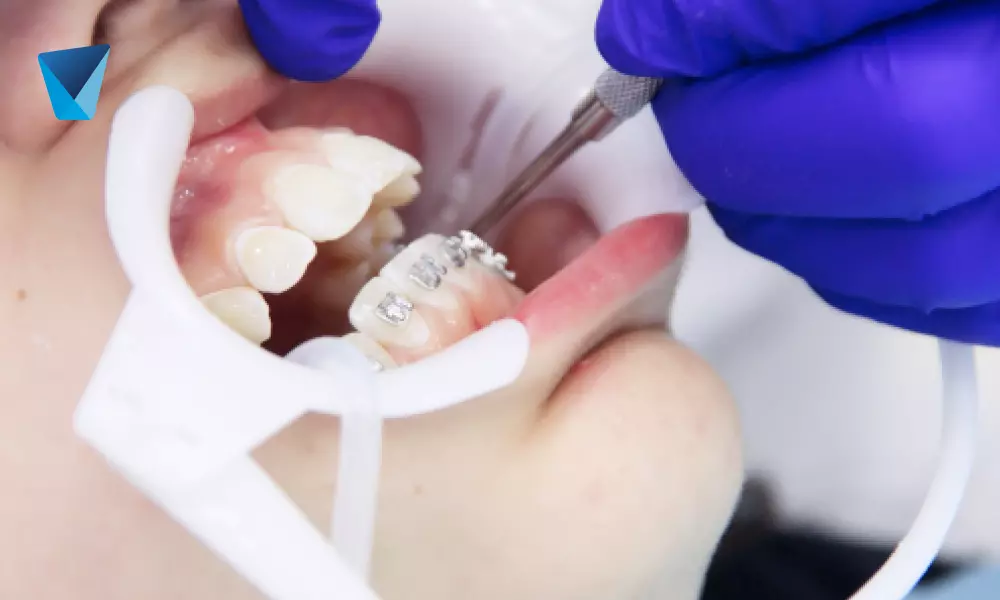 brackets dentales