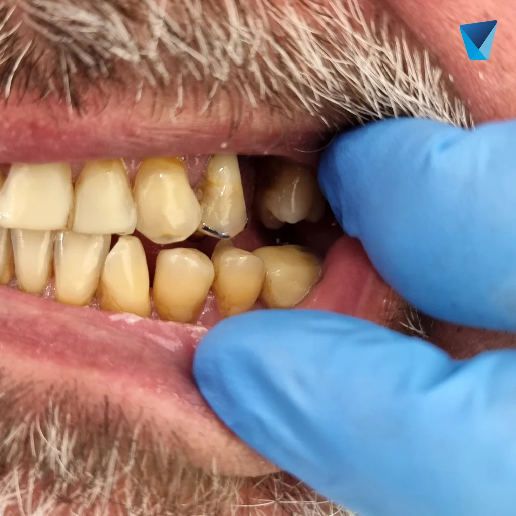 8 razones, implante dentale múltiple